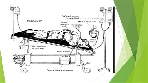 POISION DECONTAMINATION METHODS 2 GASTRIC LAVAGE Gastric lavage