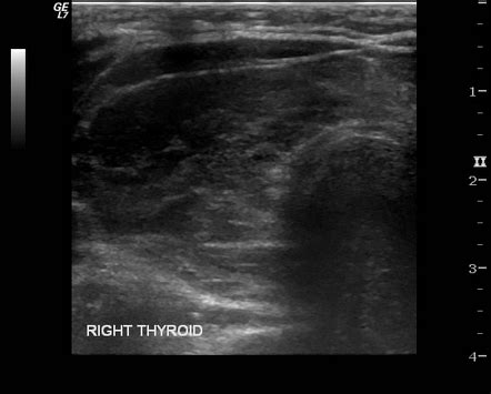 Toxic Multinodular Goiter Echocardiography Or Ultrasound Wikidoc ...