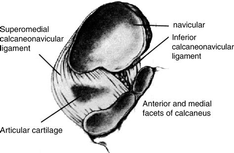 Anatomical Reconstruction of the Spring Ligament Using Peroneus Longus ...