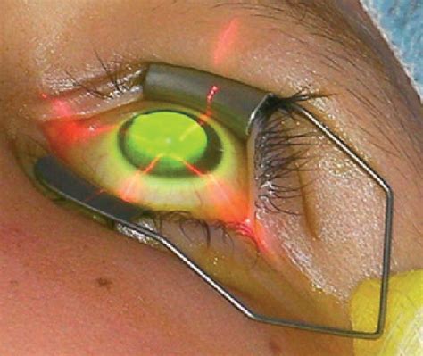 Figure 3 from Corneal cross-linking--a review. | Semantic Scholar