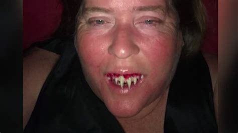 Zombie teeth: Woman gets stuck with false fangs - ABC13 Houston