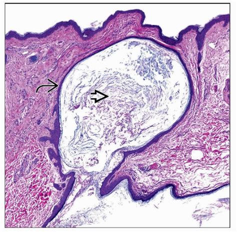 Epidermoid Cyst Histology