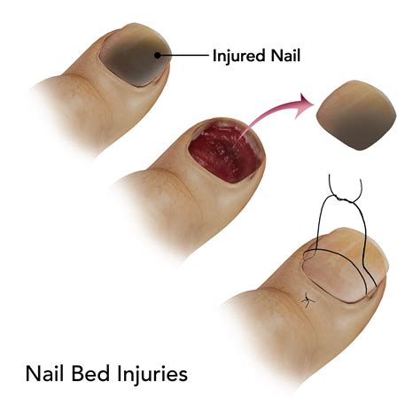 Nail Bed Injuries Springfield | Nail Injuries Treatment East Longmeadow, Chicopee