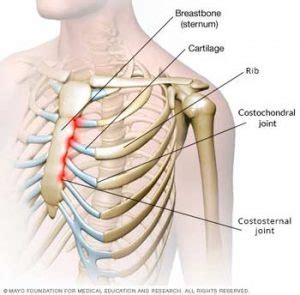 Do You Have A Dislocated Rib? - Find Out How It Feels: