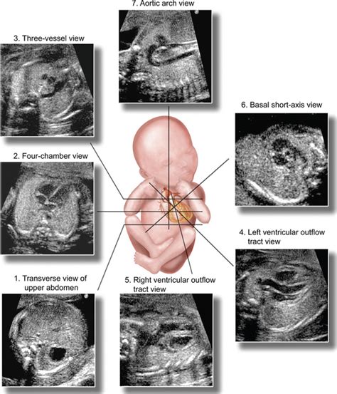 ULTRASOUND EVALUATION OF THE FETAL HEART | Radiology Key