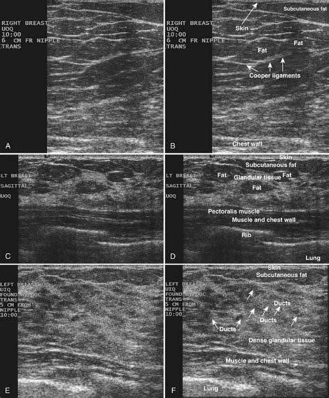 Breast Cancer Dense Breast Tissue Ultrasound | Cancer Symptom