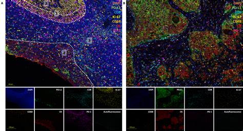 Automated Multiplex Immunofluorescence Panel for Immuno-oncology ...