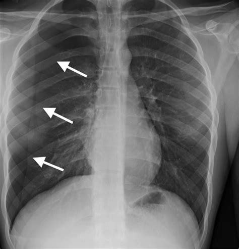 Spontaneous Pneumothorax - JETem