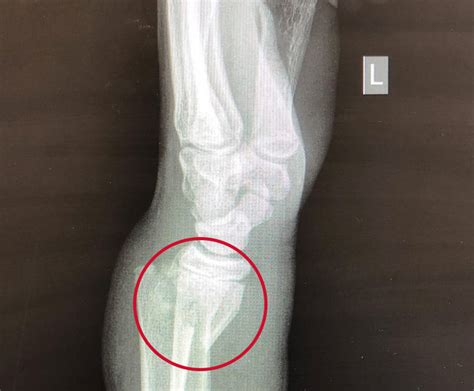 Smith Fracture (Distal Radius Fracture): Definition & Treatment