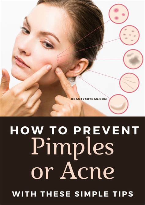 How to Prevent Pimples or Acne: Tips and Home Remedies - BeautySutras