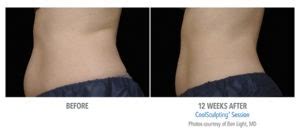 Long-term Effects of Coolsculpting | Beverly Hills | Los Angeles | West Hollywood