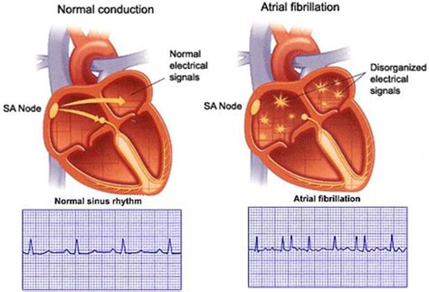 Pin on Atrial Fibrillation Treatment