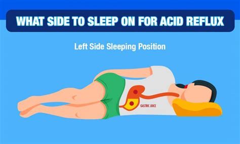 What Side to Sleep On For Acid Reflux? We Have Answer