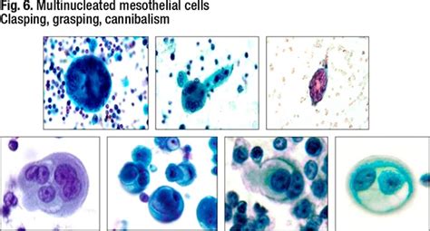 Fluid cytology—key features and ancillary testing - CAP TODAY