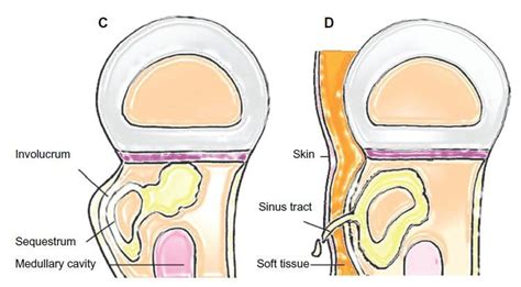 Figure 2 The pathogenesis of hematogenous osteomyelitis. (C) A segment ...