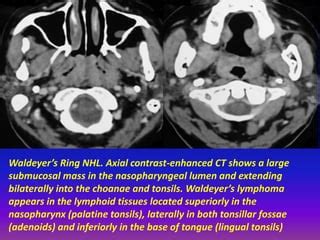 Presentation1.pptx, radiological imaging of extra nodal lymphoma. | PPT