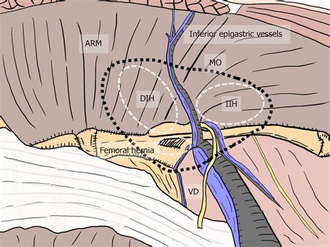 Direct Inguinal Hernia Repair