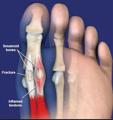 Painful Sesamoiditis