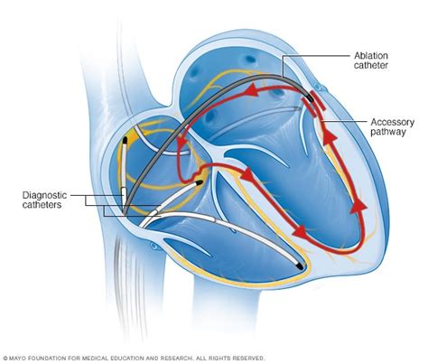 Arritmia cardíaca - Diagnóstico y tratamiento - Mayo Clinic