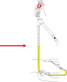 Technique for using FoleyManometer for the measurement of... | Download Scientific Diagram