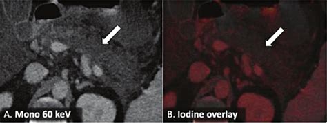 Necrotizing pancreatitis in a 33-year-old male presenting with severe... | Download Scientific ...