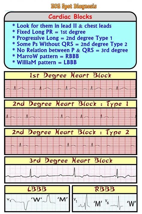 Heart Block Ecg Changes at Carlos Kittelson blog