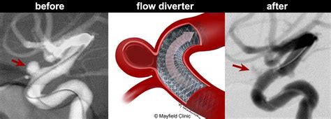 Flow Diverter OK for Smaller Wide-Neck Brain Aneurysms - The Bee Foundation