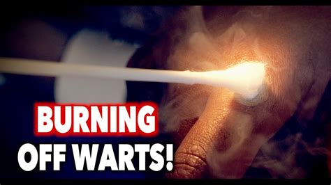 BURNING OFF WARTS! (with liquid nitrogen) | Dr. Paul - YouTube