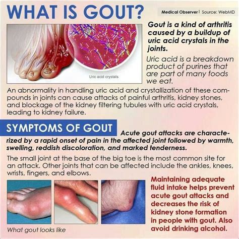 A little info for everyone about Gout and its symptoms. | Gout, Gout treatment, Nursing tips