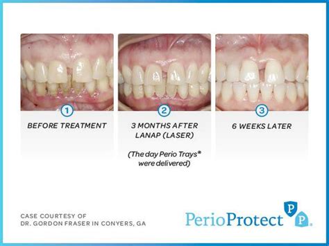 Perio Protect - Trillium Dental Columbus Ohio