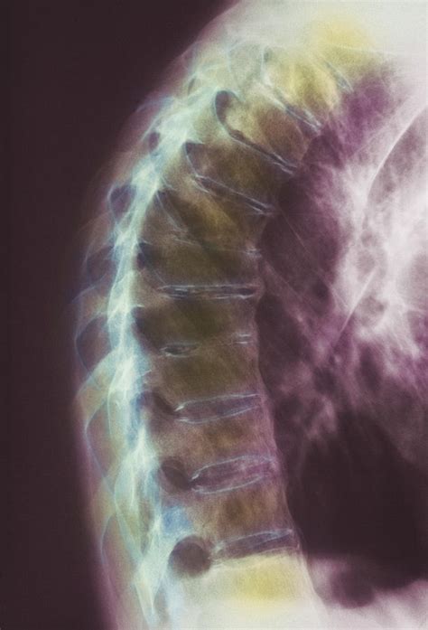 Ankylosing Spondylitis X-ray Photograph by Cnri - Fine Art America