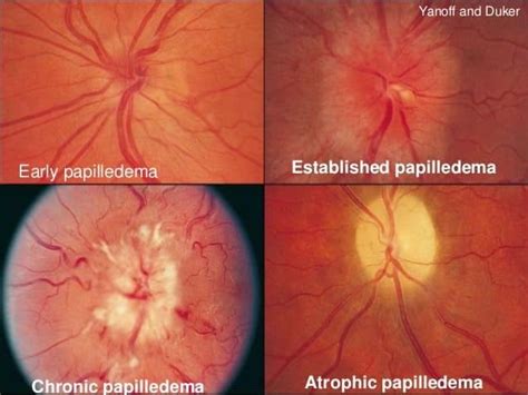 Papilledema #IIH