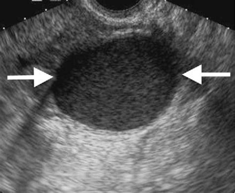 Complex Ovarian Cyst Ultrasound