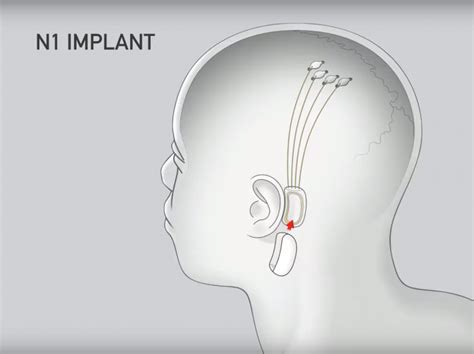 Neuralink Chip Never Damages Nervous System or Cause Any CSF Leak, Says ...