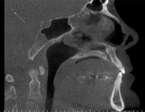 Anatomy Monday: Pineal Gland Calcification – Dr. G's Toothpix