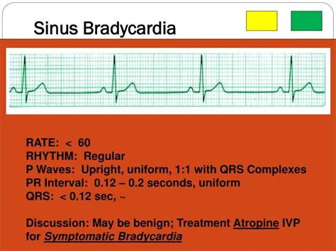 PPT - Cardiovascular--- EKG’s / Cardiac Monitoring PowerPoint Presentation - ID:2350898