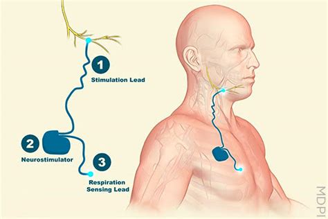 OSA: What Role for Hypoglossal Nerve Stimulation? - Excessive Sleepiness and Associated Risks ...