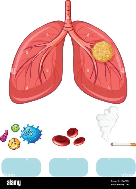 Lung cancer diagram with virus and cigarette Stock Vector Image & Art - Alamy