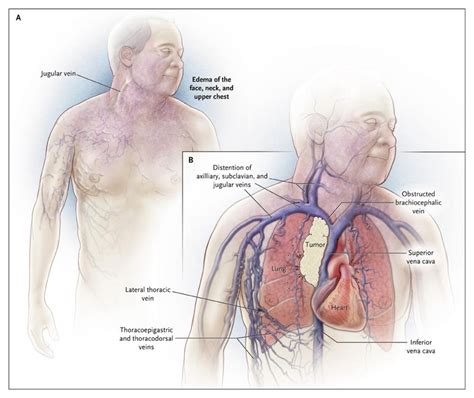 Vena Cava Syndrom Symptome - Captions Beautiful