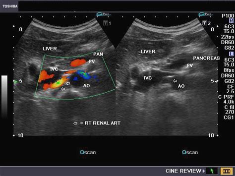 A Gallery of High-Resolution, Ultrasound, Color Doppler & 3D Images - Vascular