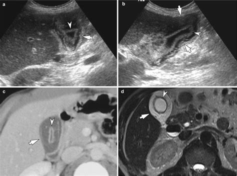 Cholecystitis and Adenomyomatosis | Radiology Key