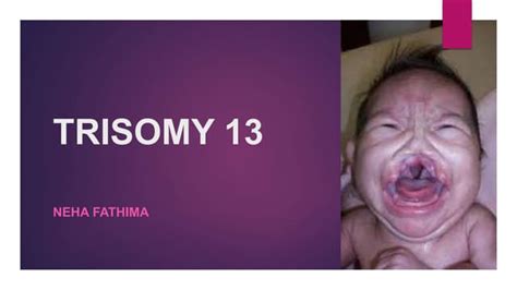 trisomy 18 and trisomy 13.pptx