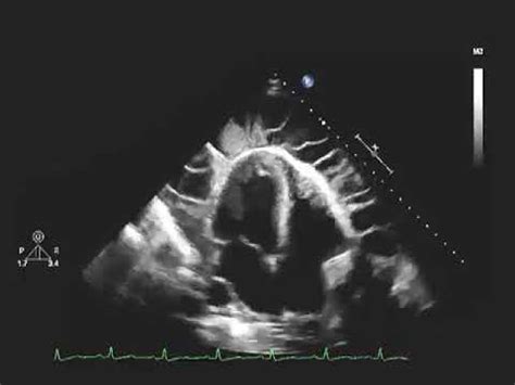 Echocardiogram of a Patient with Uremic Pericarditis. - YouTube