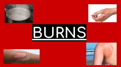 all about burns! Diagram | Quizlet