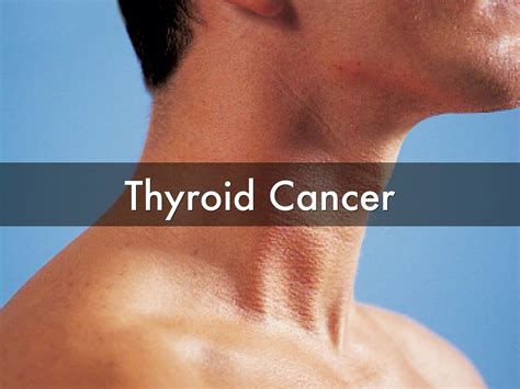 Thyroid Cancer - Types - Signs, Symptoms, Stages & Treatment