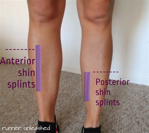 Running Without Injuries: Why Do I Get Shin Splints?