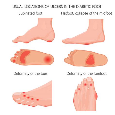 Diabetic Foot Symptoms & Signs You Should Know – Footwear News