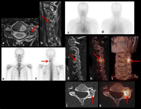 Osteoid osteoma in a 23-year-old man with pain in the neck for several... | Download Scientific ...