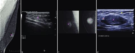 Angiolipoma: Male patient presented with palpable abnormality (a and... | Download Scientific ...