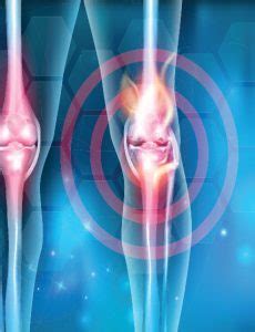 Arthritis Knee Pain Center Lexington, KY | Arthritis Knee Pain Centers